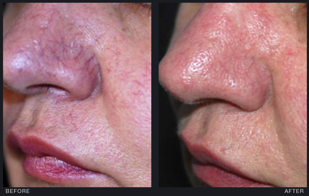 Vascular Lesions Treatment (1" Up to 2" of Broken Capillaries)